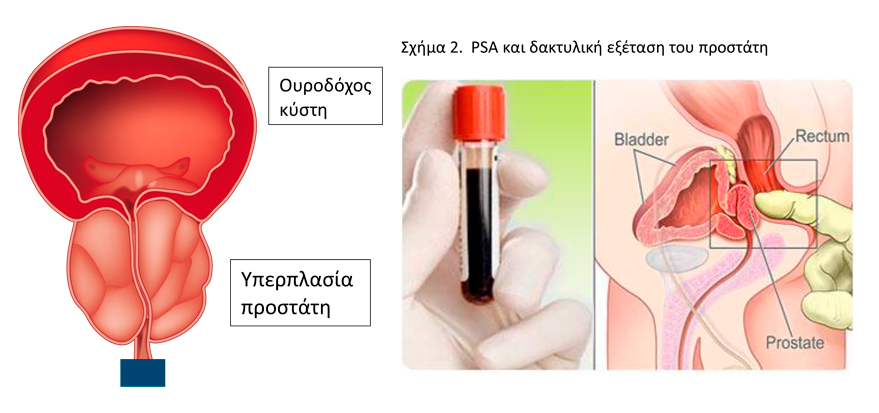 prostatis